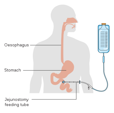 Diagram_showing_the_position_of_a_percutaneous_jejunostomy_feeding_tube_CRUK_342.svg